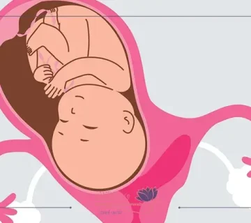 الحمل مع وجود الحاجز الرحمي