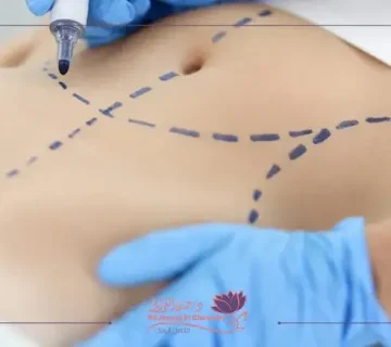 تصحيح عيوب عمليات التجميل النسائي السابقة