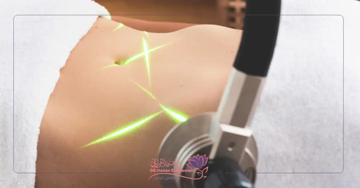 توريد وتفتيح المناطق الحساسة بالليزر