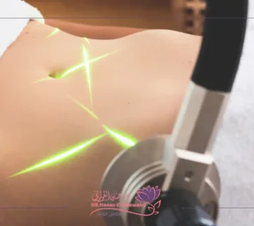 توريد وتفتيح المناطق الحساسة بالليزر